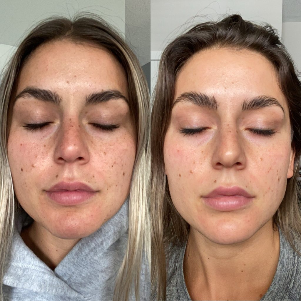 IPL Photofacial Treatment - illumin 8 skin