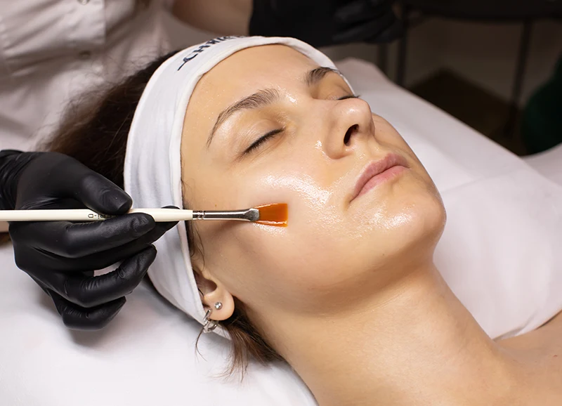 Facial chemical peel therapy.